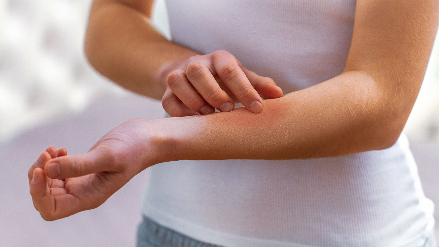 Allergien und Hautausschläge sind ein häufiges Symptom einer nachlassenden Immunität.